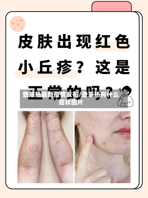 登革热最新疫情发布/登革热有什么症状图片-第1张图片